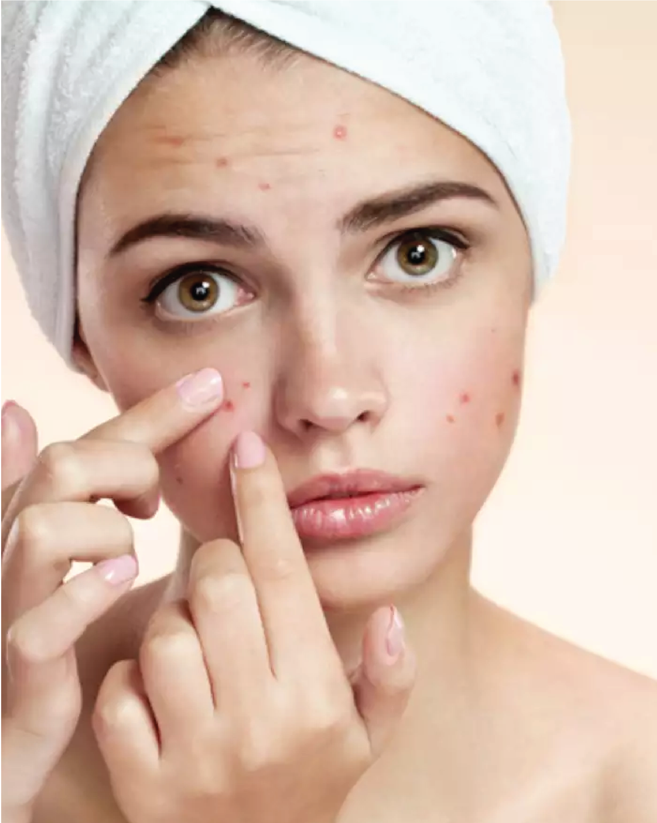 SP Biotech Beauty PLT | 痤疮精华
